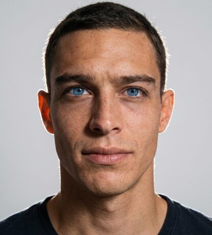 Resultat naturel peau keratopigmentation 7